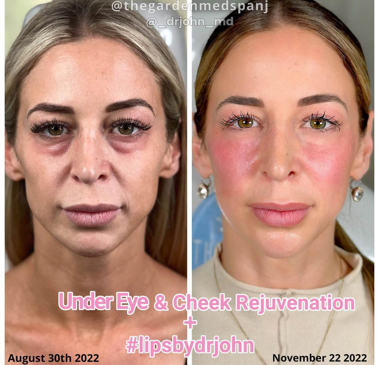 Dermal Filler Cheeks Under Eye #4