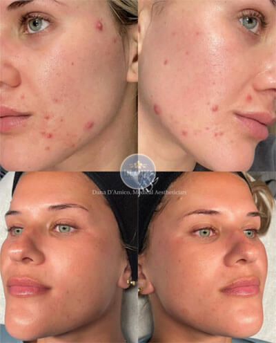 Acne Boot Camp Results 2