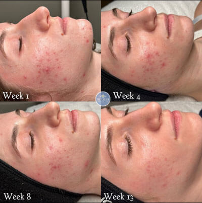 Acne Boot Camp Results 5