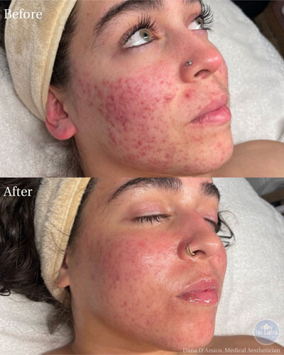 Acne Boot Camp Results 7