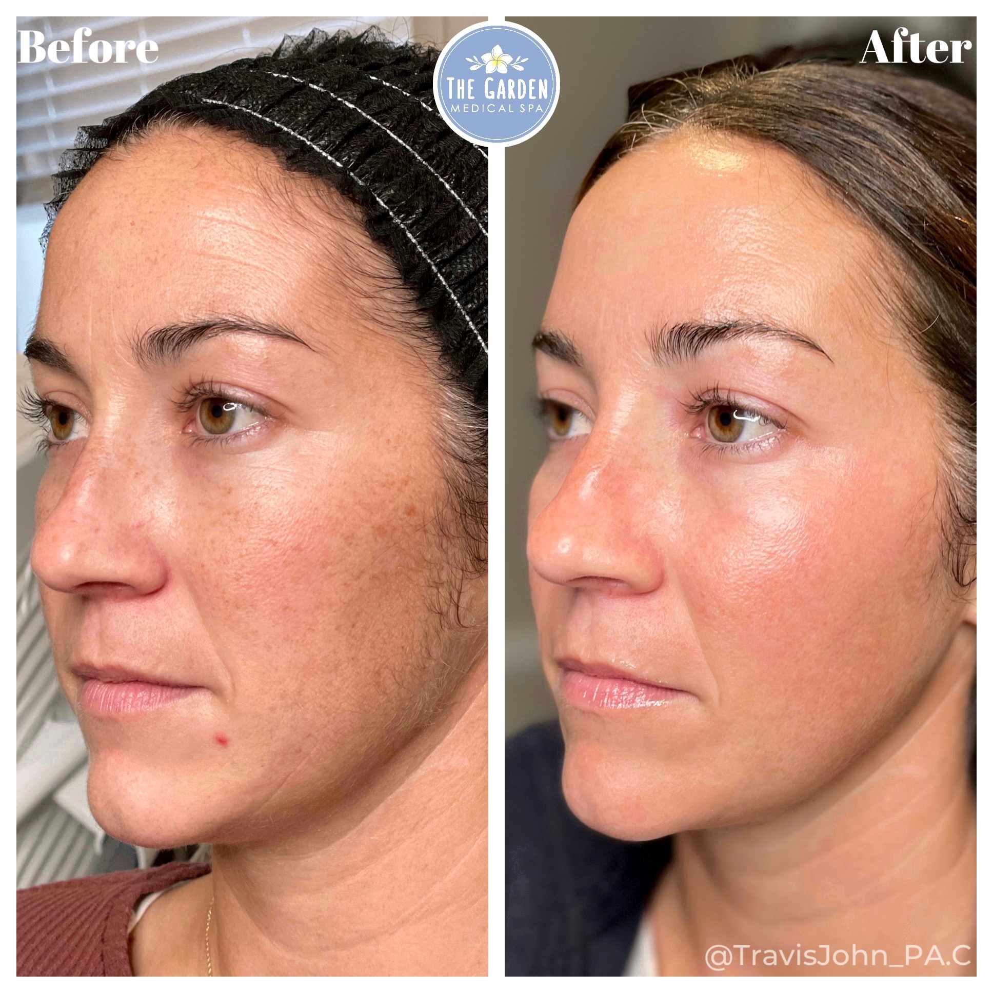 CO2 laser resurfacing removes skin damage