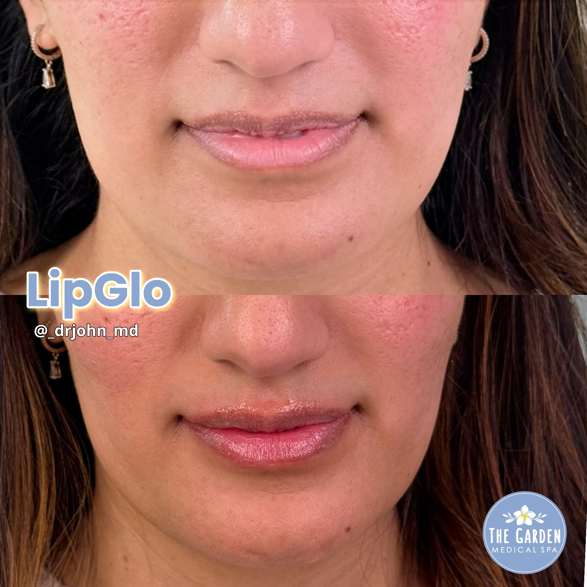 LipGlo Graden Medical Spa 2