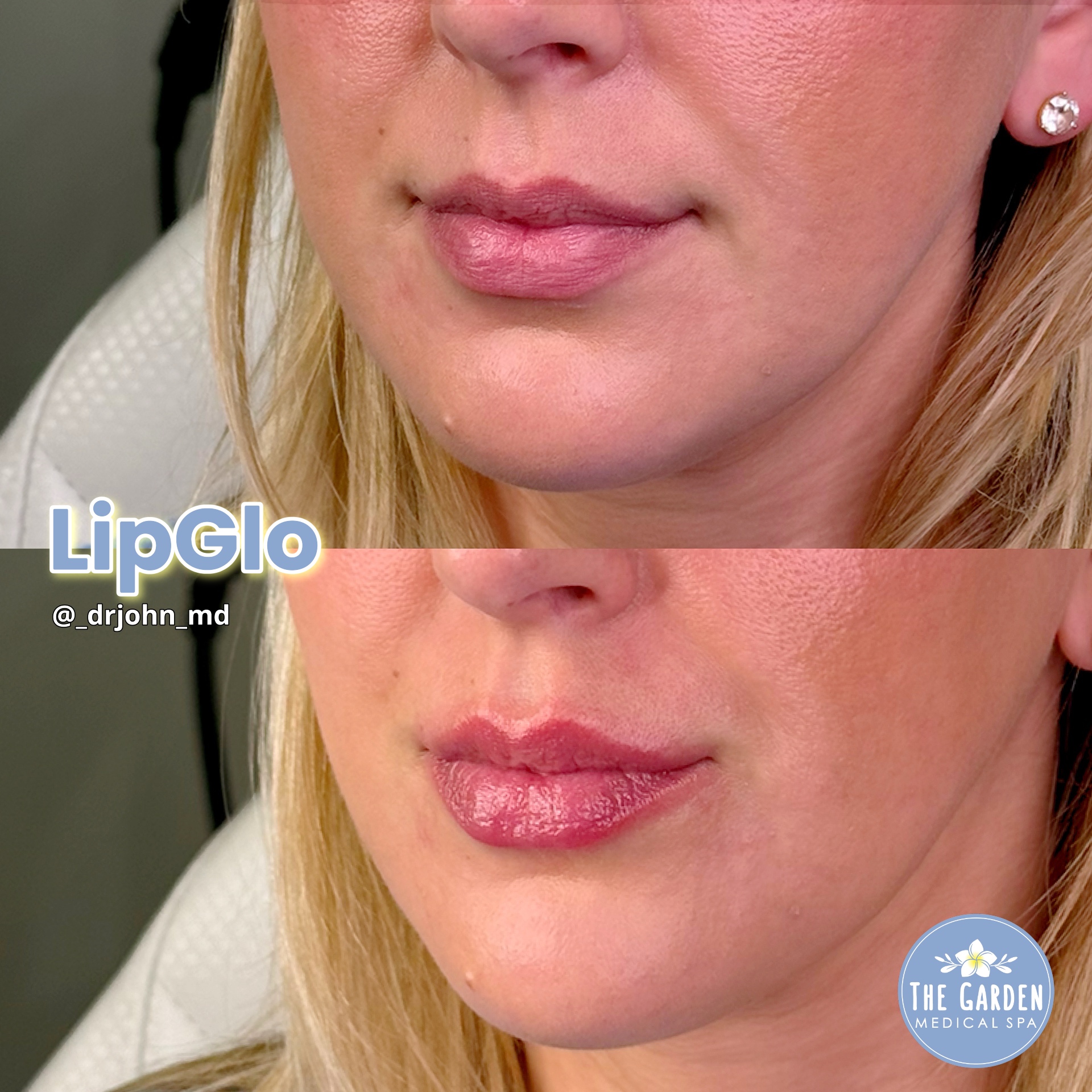 LipGlo Graden Medical Spa 3