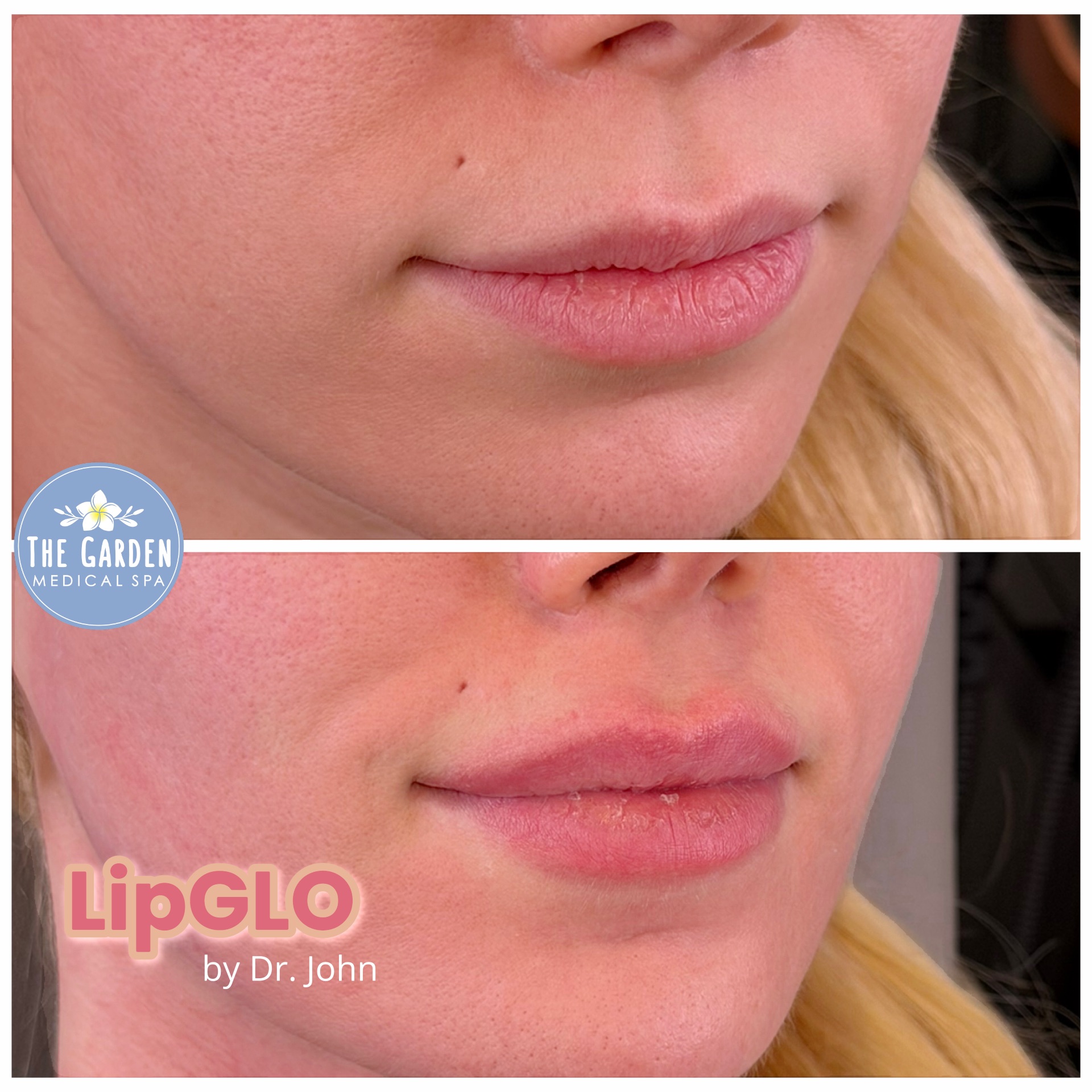LipGlo stimulates natural collagen
