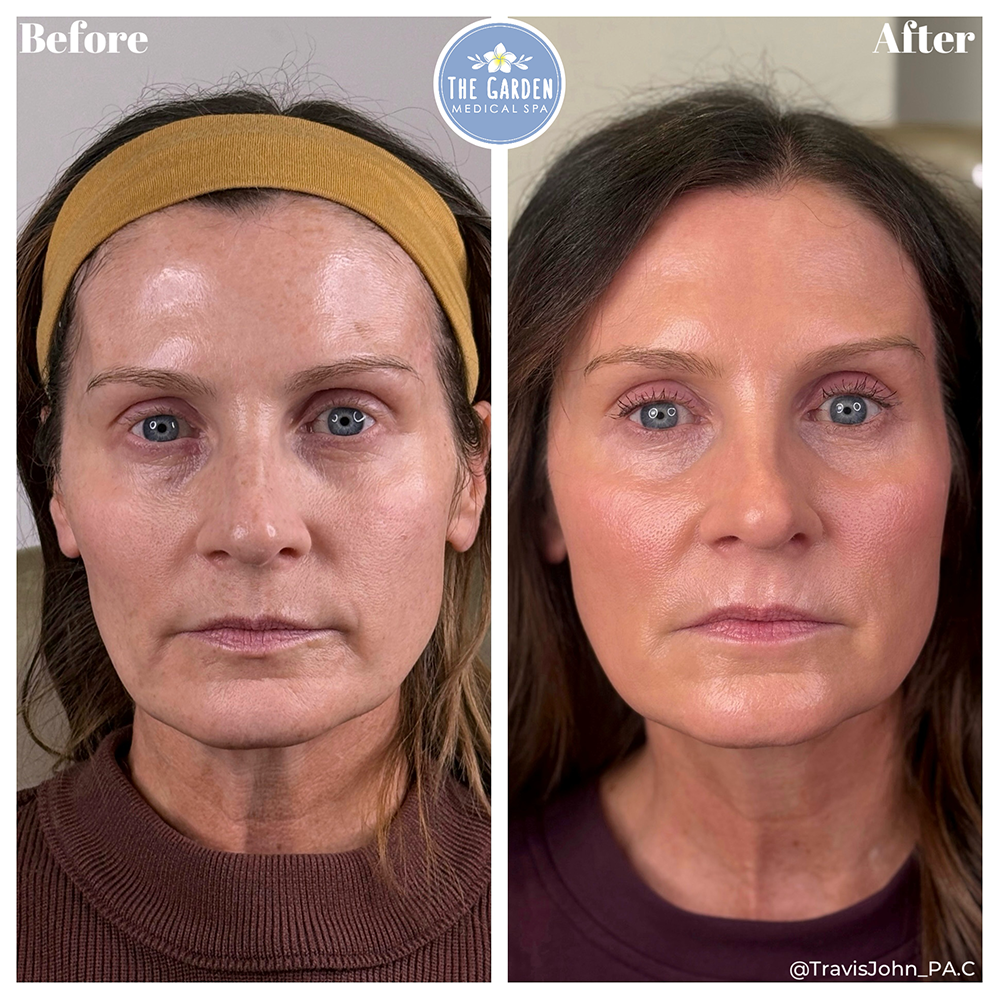 Smooth Tone Before & After NJ Face & Nose