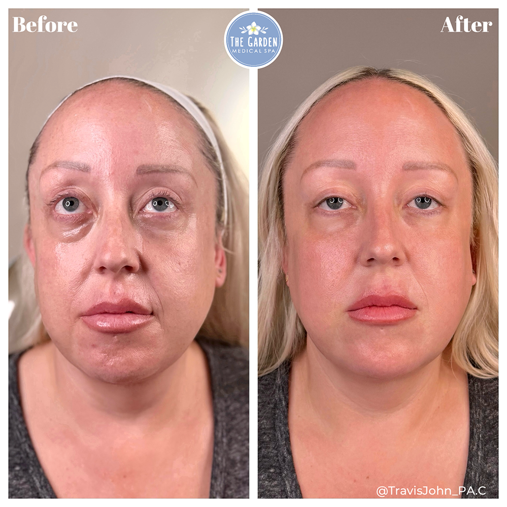 Smooth Tone Before & After NJ Face