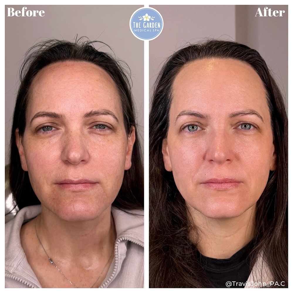 Smooth Tone Before & After NJ