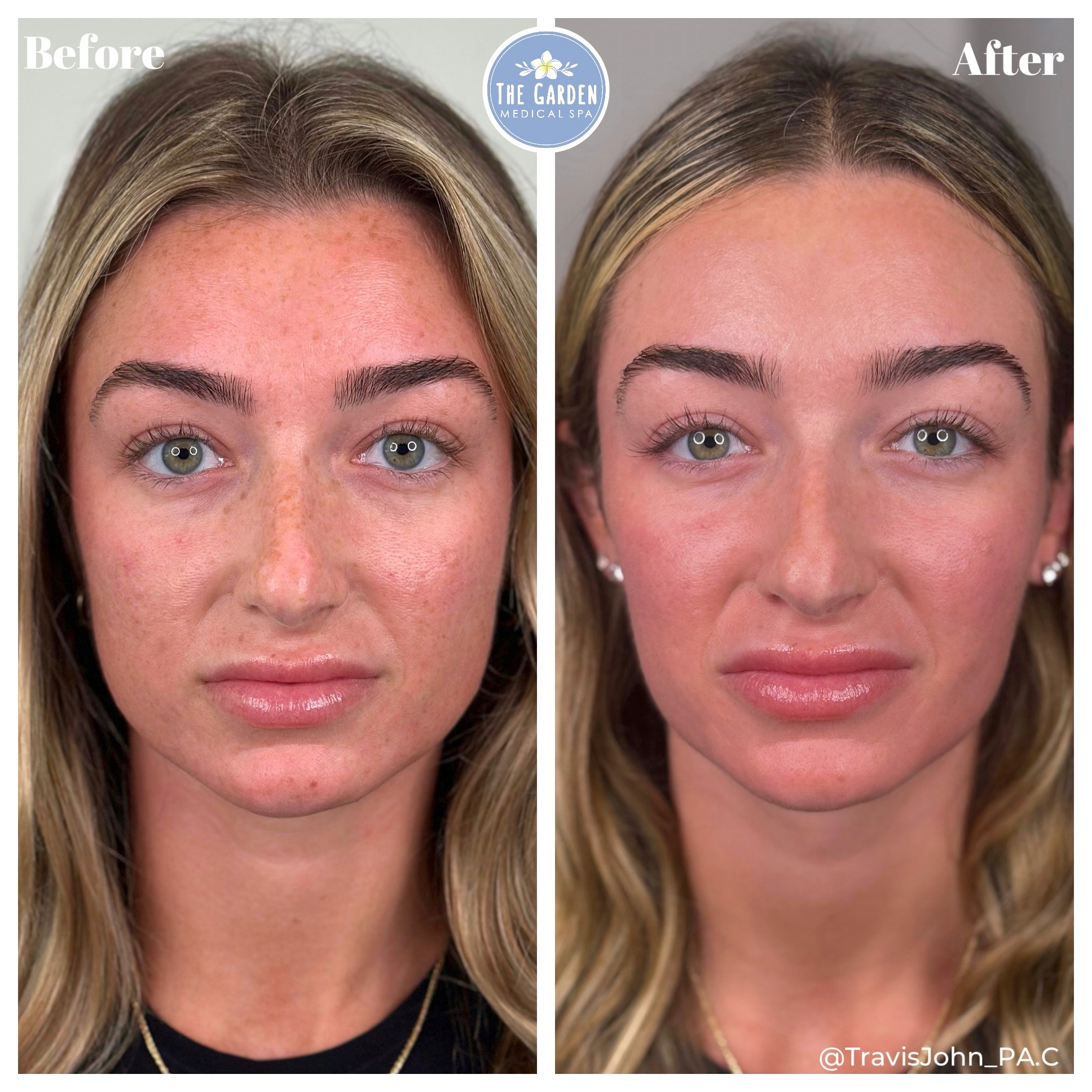 Smooth Tone The Garden Med Spa Before & After