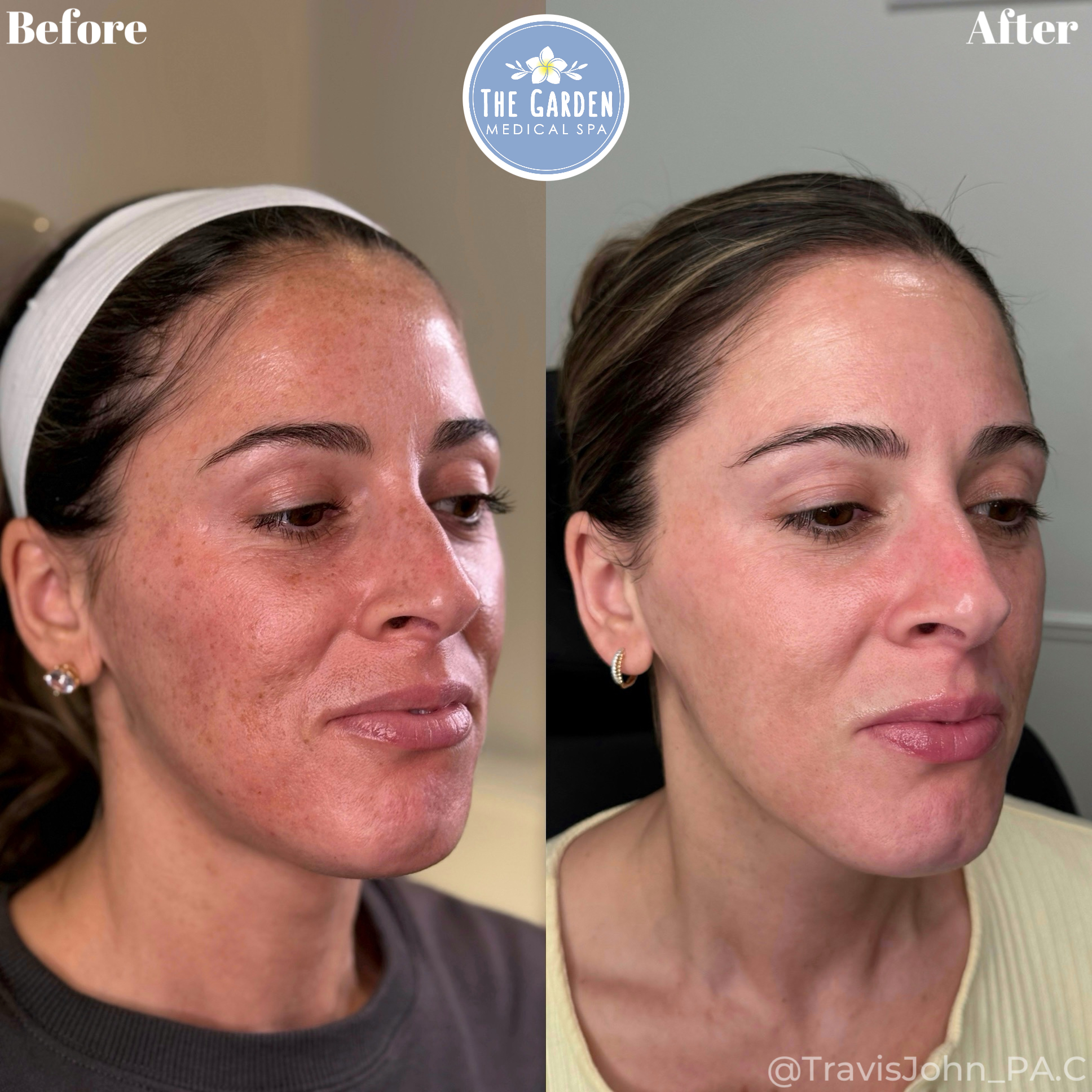Smooth Tone The Garden Med Spa Work