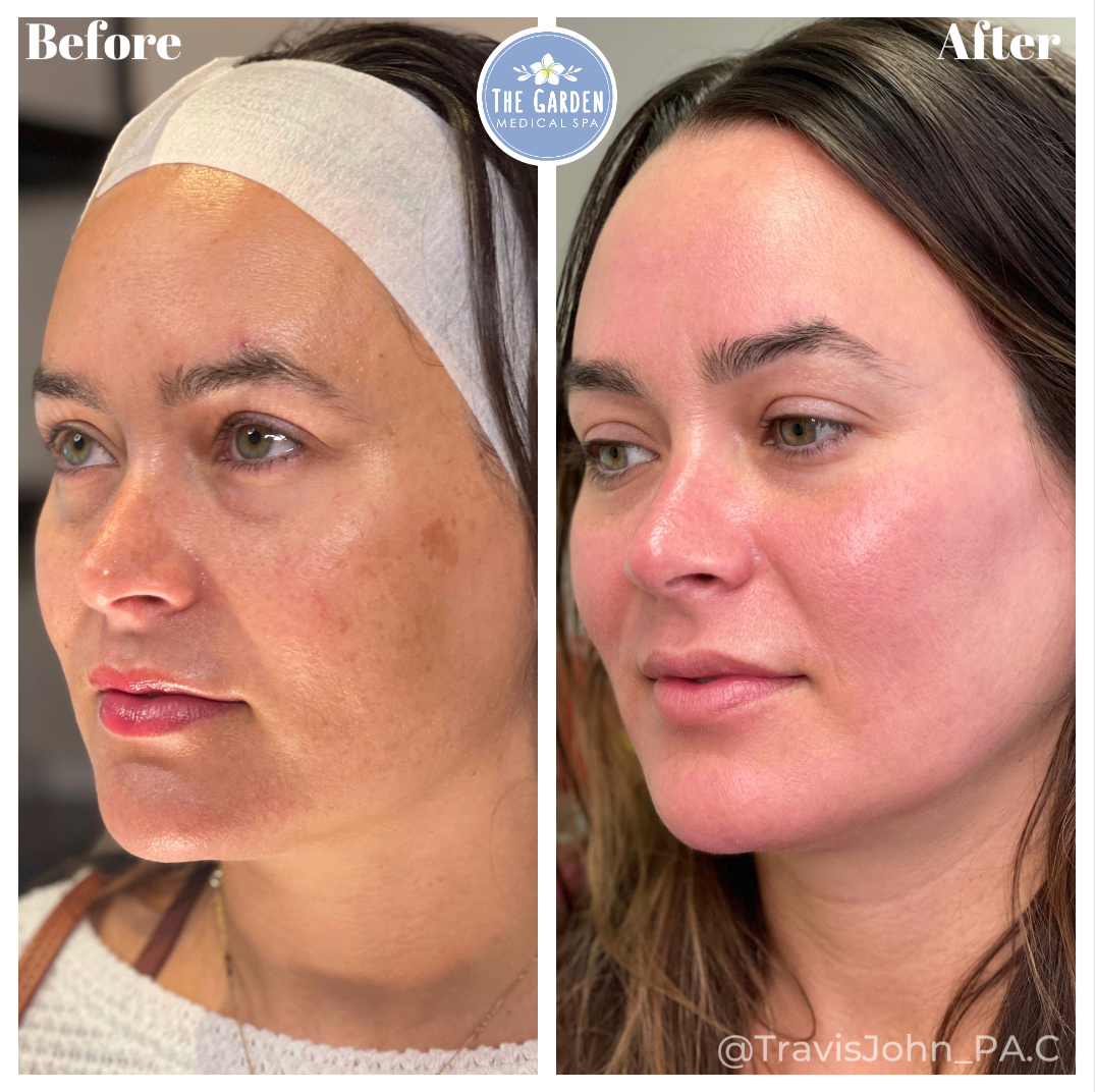 Smooth Tone The Garden Med Spa