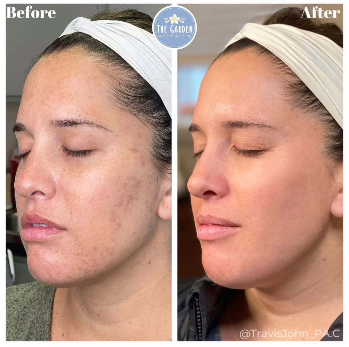 SmoothTone Before & After Photos